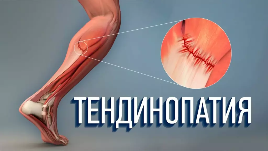 тендинопатия