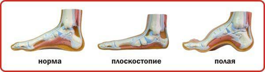 Форма стопы: нормальная стопа, плоская стопа (плоскостопие), Полая стопа