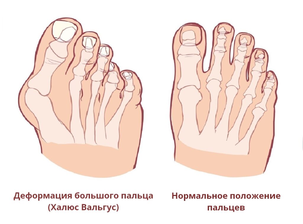 деформация большого пальца стопы