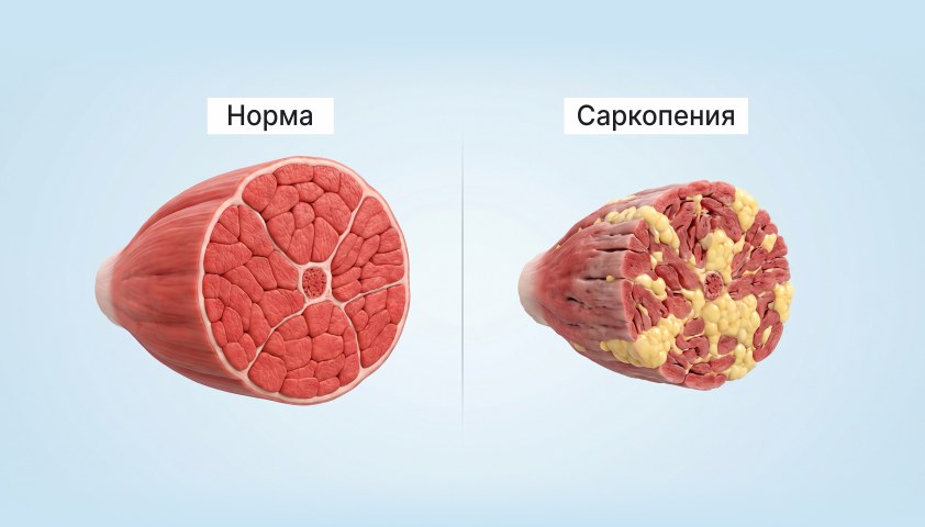саркопения